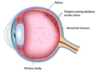 Floaters and flashes in the field of vision