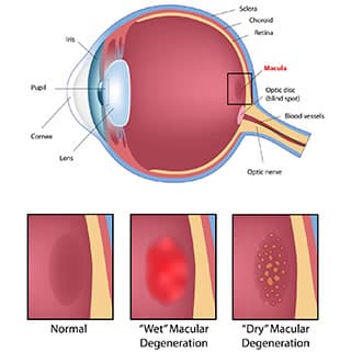 The macula at the centre of the retina, with the changes seen in dry and wet macular degeneration