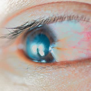 A pterygium growing across the surface of the eye