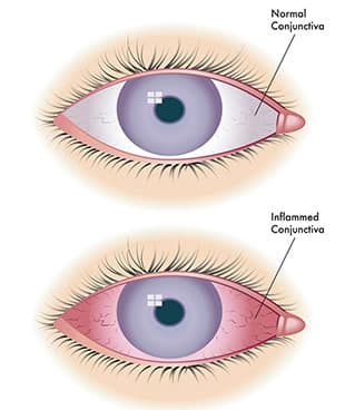 An eye affected by uveitis