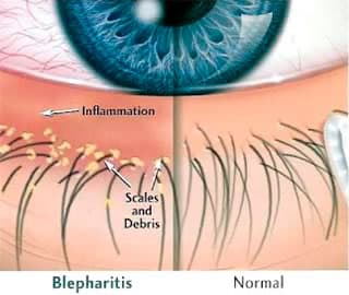 An inflamed eyelid margin caused by blepharitis