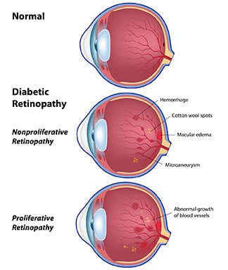 Retina showing the changes of diabetic retinopathy