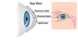 Close-up of an eye affected by dry eye syndrome