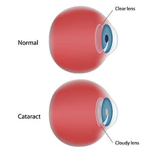 A clear lens compared with a cataract